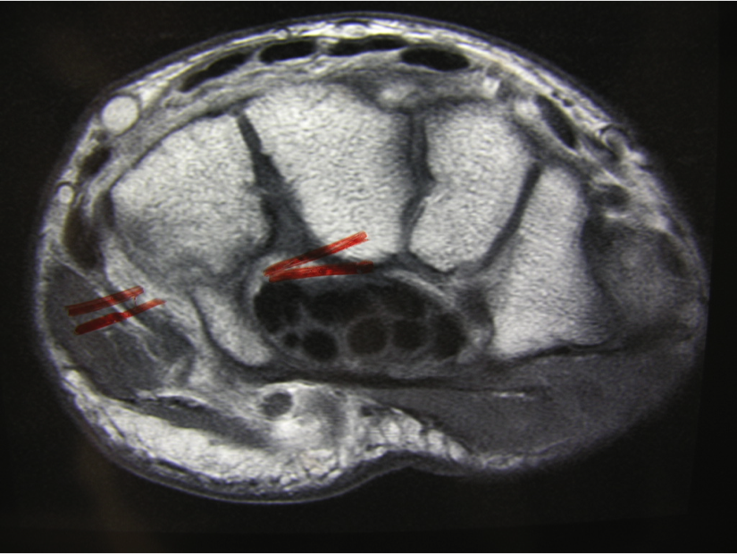 Hamate Hook Fracture MRI