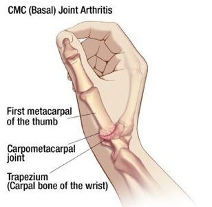 Basal Joint Arthritis Diagram