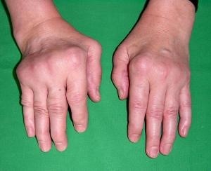 Rheumatoid Arthritis of Hand Photo