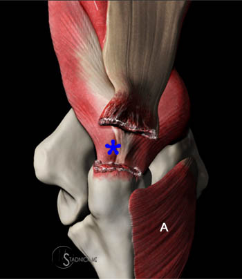 Distal Biceps Function Figure